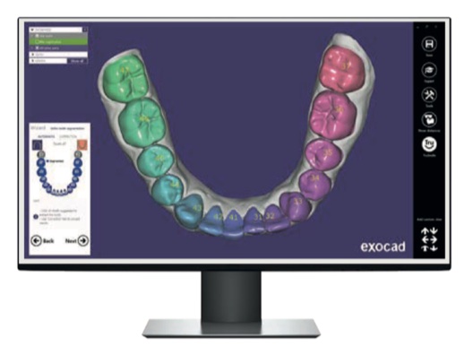 exocad dental cad software